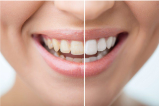 歯の“黄ばみ”の原因は？